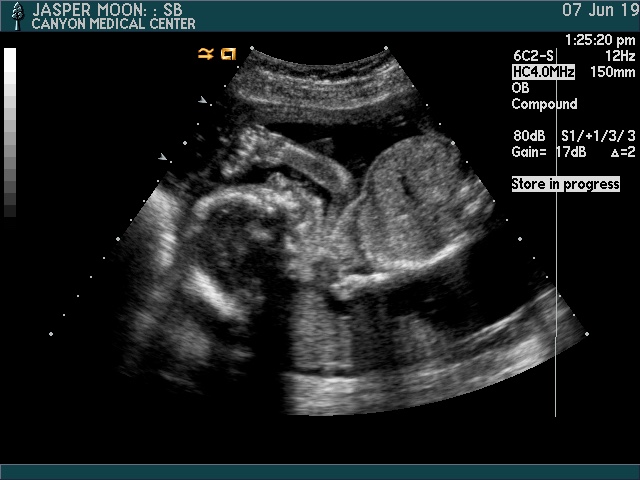 Baby 2, 20 week ultrasound.
